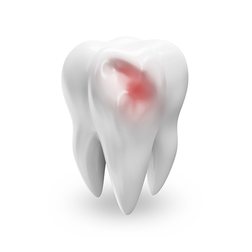 root canals in Temple City treat tooth pain root canals in Temple City treat tooth pain