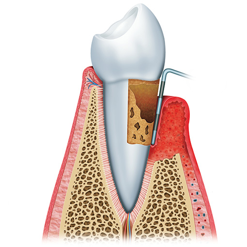 gum disease is dangerous gum disease is dangerous