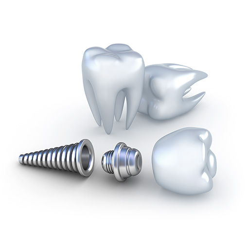 Temple City dental implants Temple City dental implants