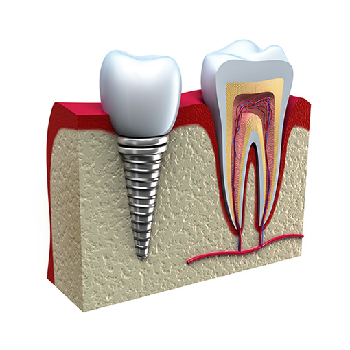 dental implants work like magic dental implants work like magic