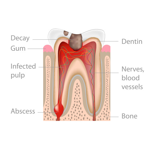 root canal indications Temple City root canal indications Temple City