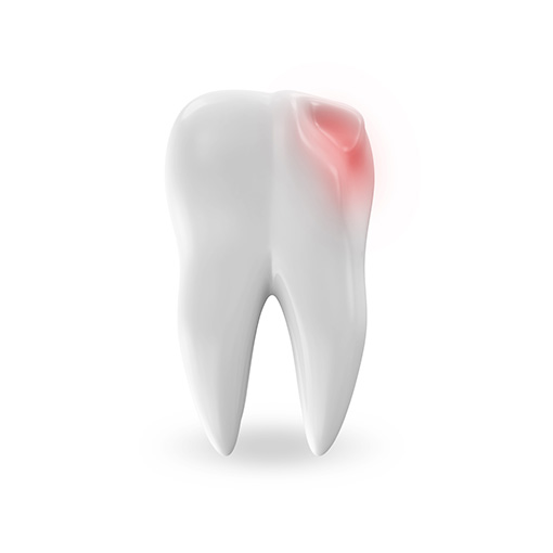 tooth decay pain relief in Temple City tooth decay pain relief in Temple City